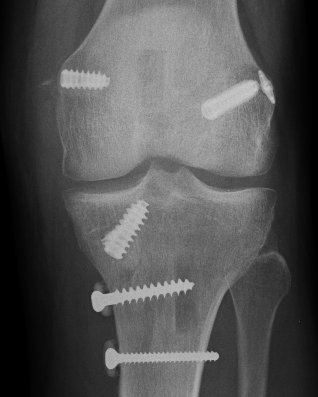 MCL Reconstruction Tendoachilles allograft